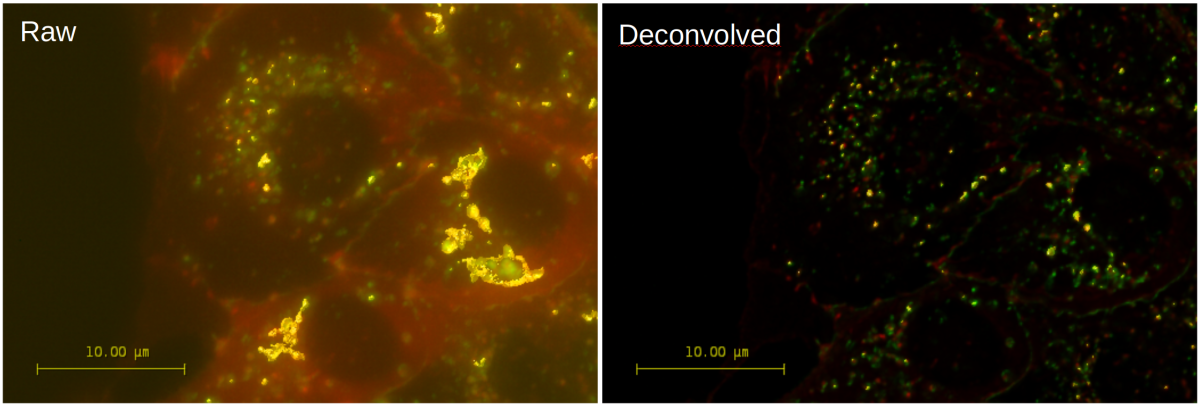 The raw 3D widefield image (left) and its deconvolved version (right) have been analyzed with Huygens Colocalization Analyzer. Note that the removal of blurring and noise by deconvolution completely changes the colocalization between stained p120 catenin (red) and Claudin (green) in these MDCK cells. The colocalization regions are visualized in yellow as a isosurface rendered map (based on the Pearson value) and projected on a MIP of both channels. Data used by permission from Dr. Johan de Rooij - Hubrecht Institute, Utrecht, The Netherlands
