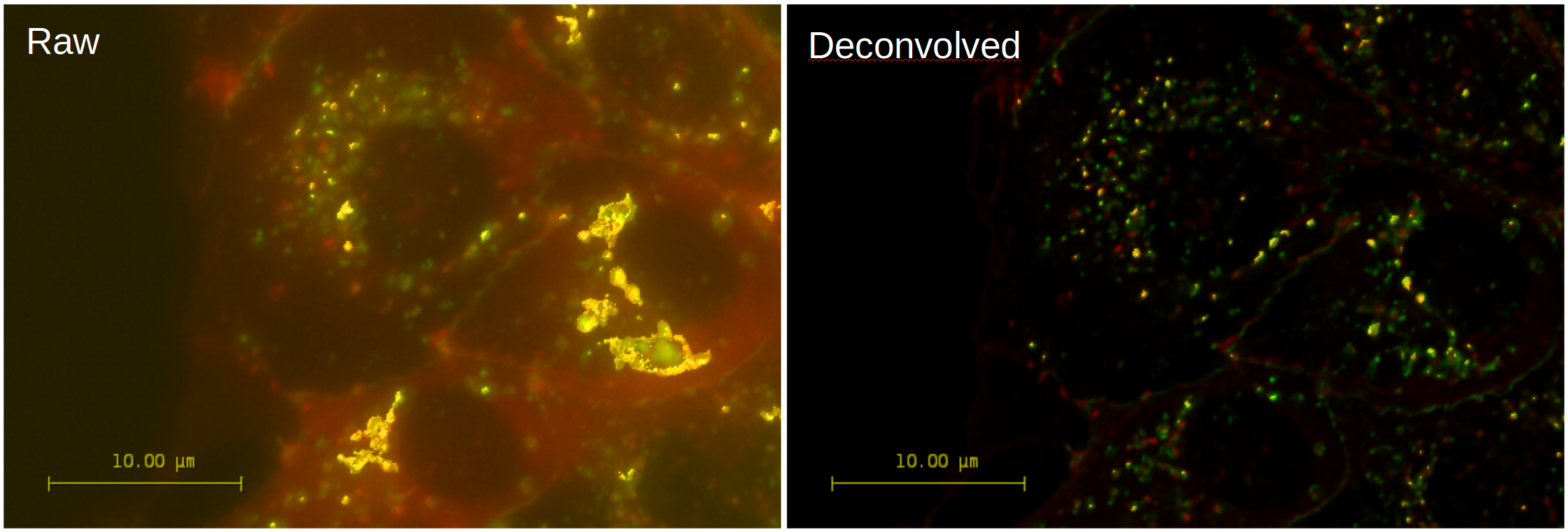 The raw 3D widefield image (left) and its deconvolved version (right) have been analyzed with Huygens Colocalization Analyzer. Note that the removal of blurring and noise by deconvolution completely changes the colocalization between stained p120 catenin (red) and Claudin (green) in these MDCK cells. The colocalization regions are visualized in yellow as a isosurface rendered map (based on the Pearson value) and projected on a MIP of both channels. Data used by permission from Dr. Johan de Rooij - Hubrecht Institute, Utrecht, The Netherlands